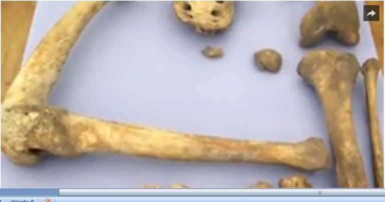 BBC History Cold Case York 113 fused leg bone.JPG