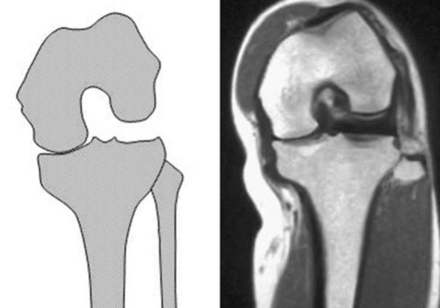 bent knee showing normal flexion and how joint opens.JPG