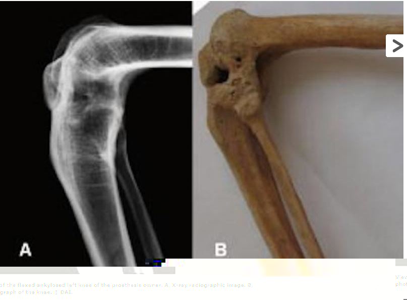 Chinese ankylosed knee 3 to 2 C BC.JPG